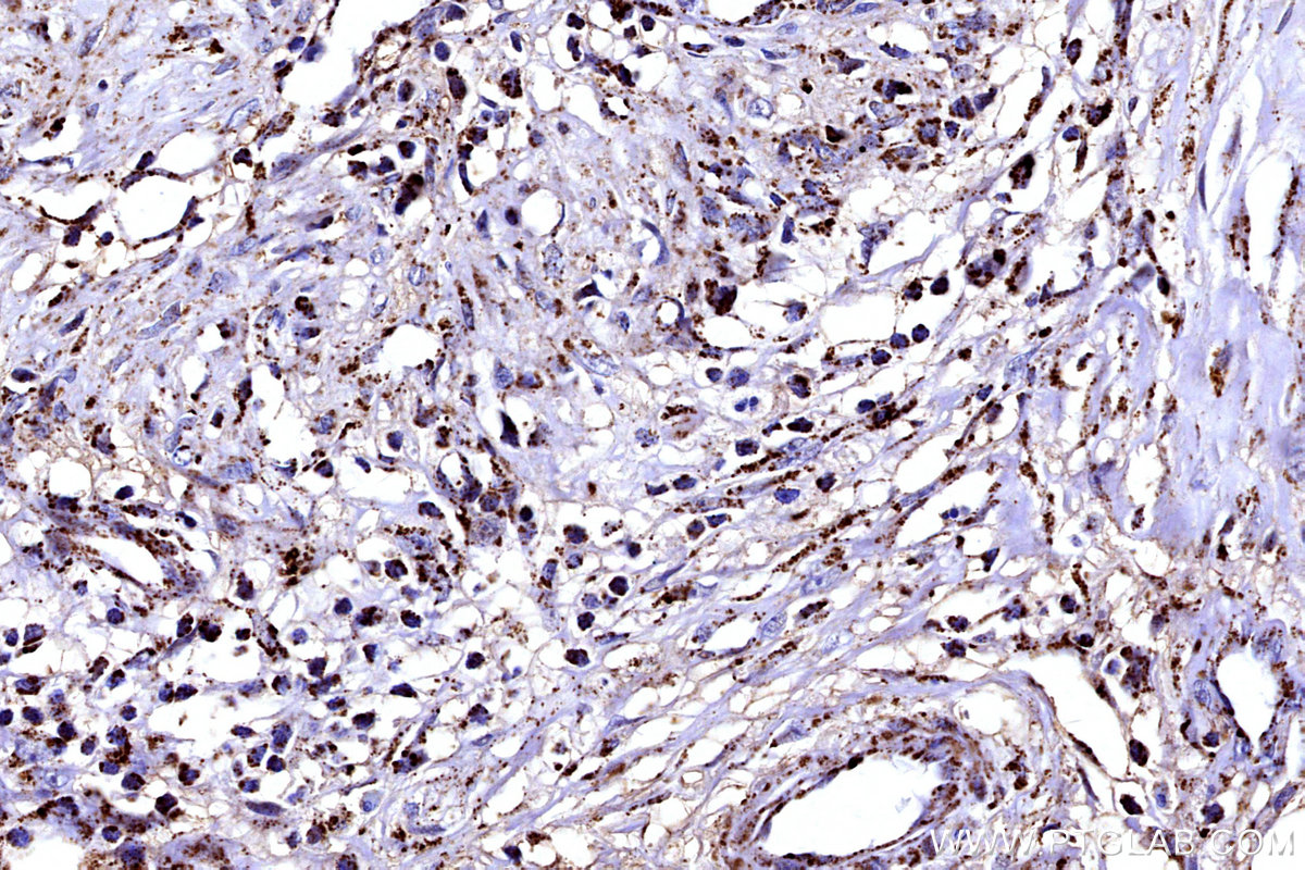 IHC staining of human colon cancer using 12592-1-AP IHC staining of human colon cancer using 12592-1-AP