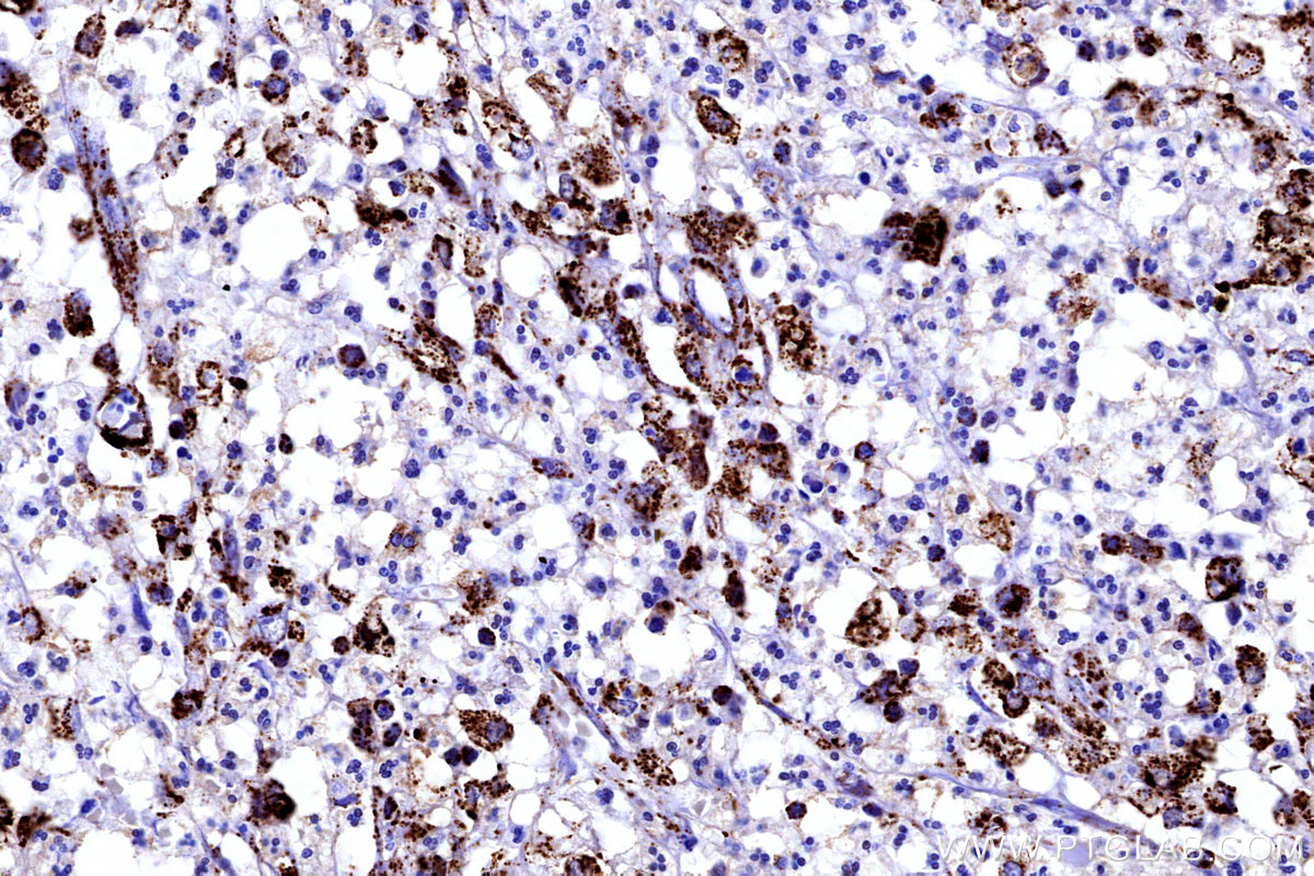 IHC staining of human colon cancer using 12592-1-AP IHC staining of human colon cancer using 12592-1-AP