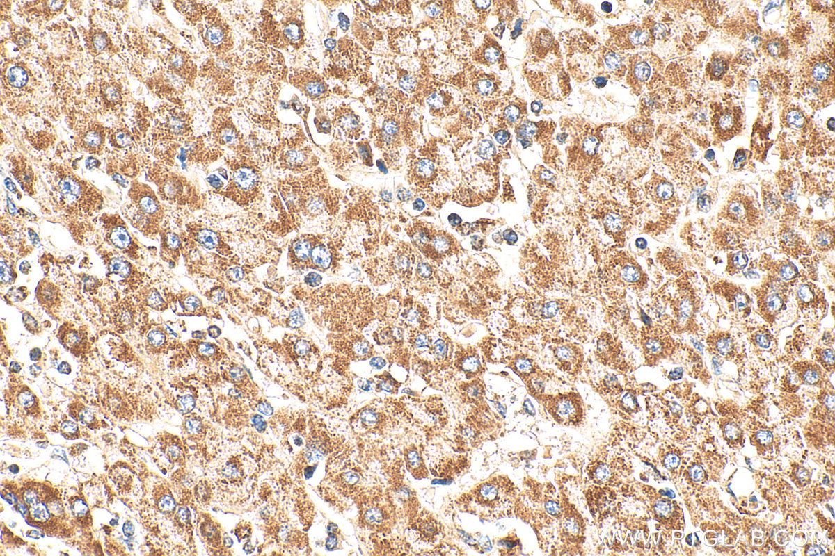 IHC staining of human liver cancer using 14466-1-AP