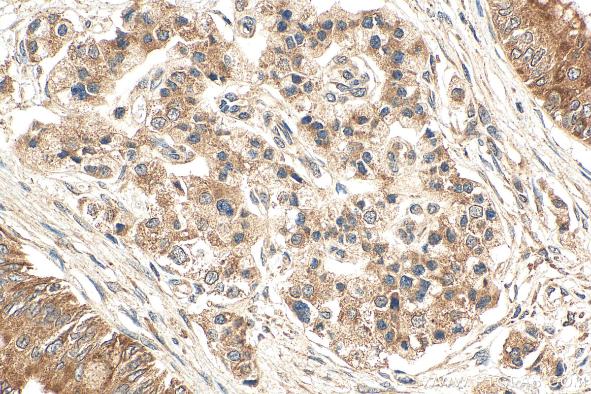 IHC staining of human pancreas cancer using 19544-1-AP