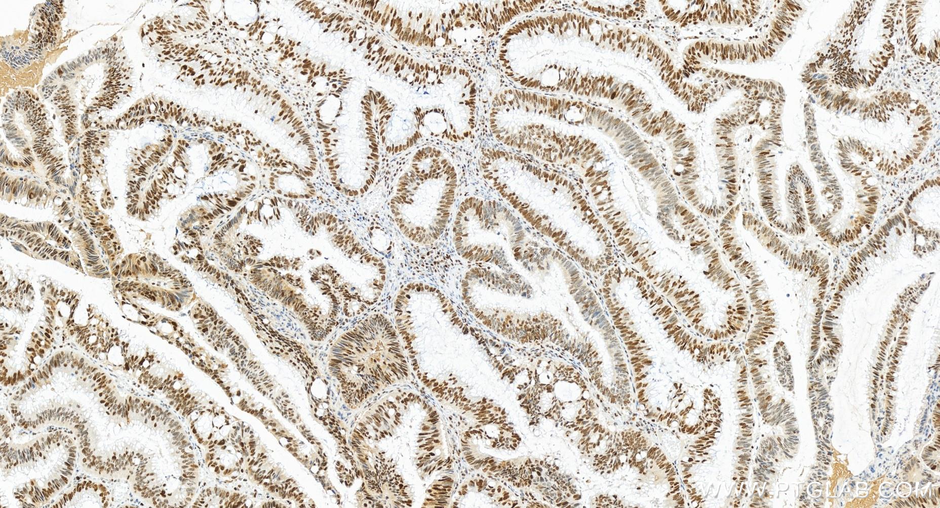 IHC staining of human colon cancer using 84916-5-RR