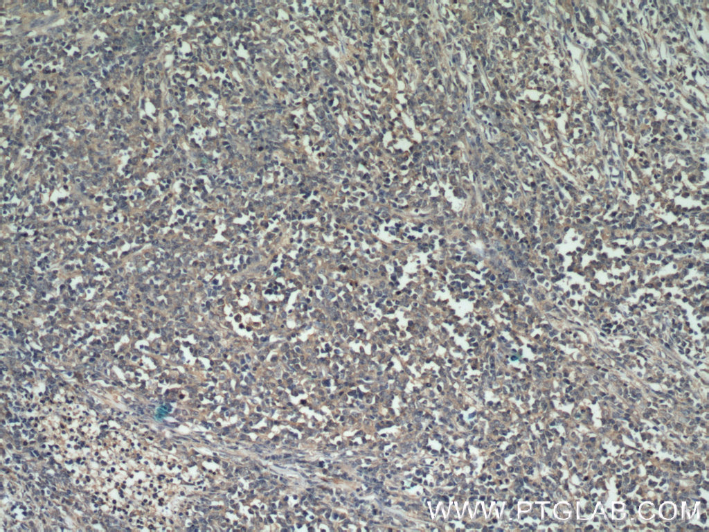 IHC staining of human lymphoma using 18131-1-AP