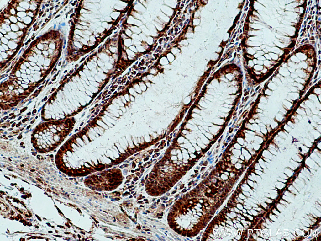 IHC staining of human colon cancer using 28194-1-AP