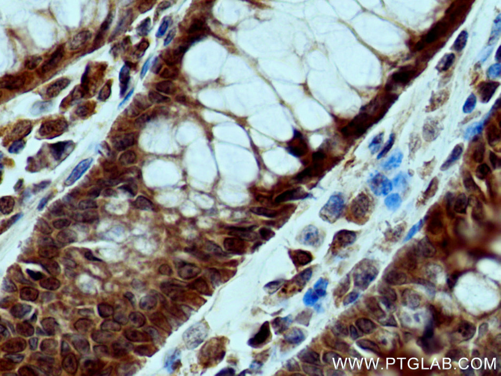 IHC staining of human colon cancer using 28194-1-AP