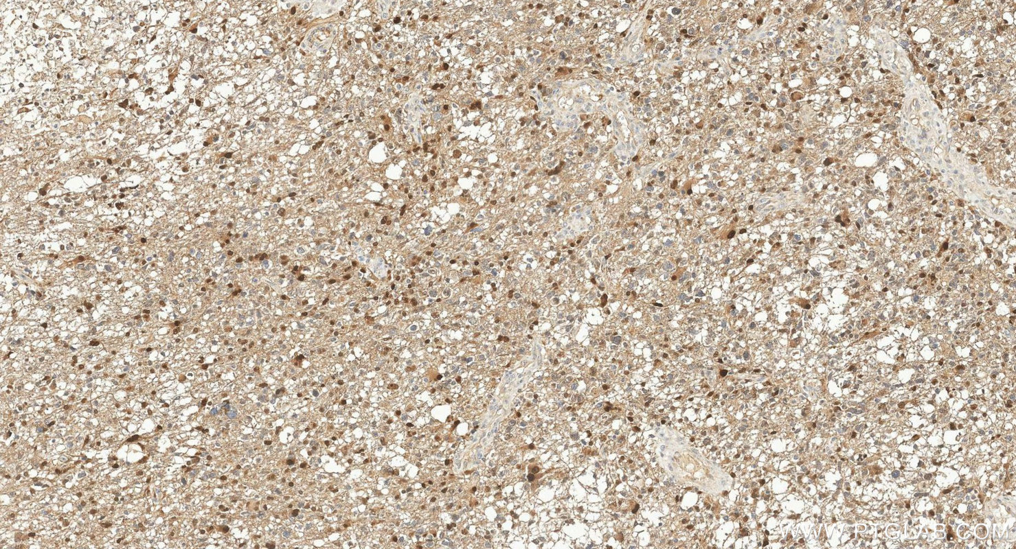IHC staining of human gliomas using 30333-1-AP IHC staining of human gliomas using 30333-1-AP