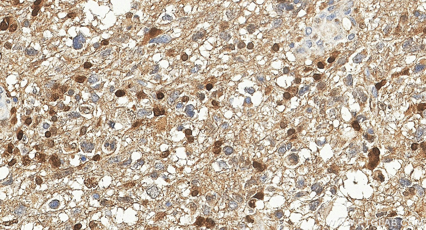 IHC staining of human gliomas using 30333-1-AP IHC staining of human gliomas using 30333-1-AP