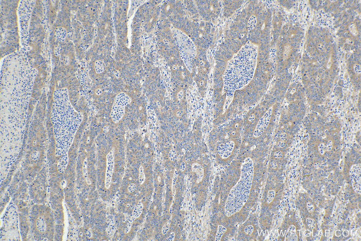 IHC staining of human colon cancer using 17400-1-AP