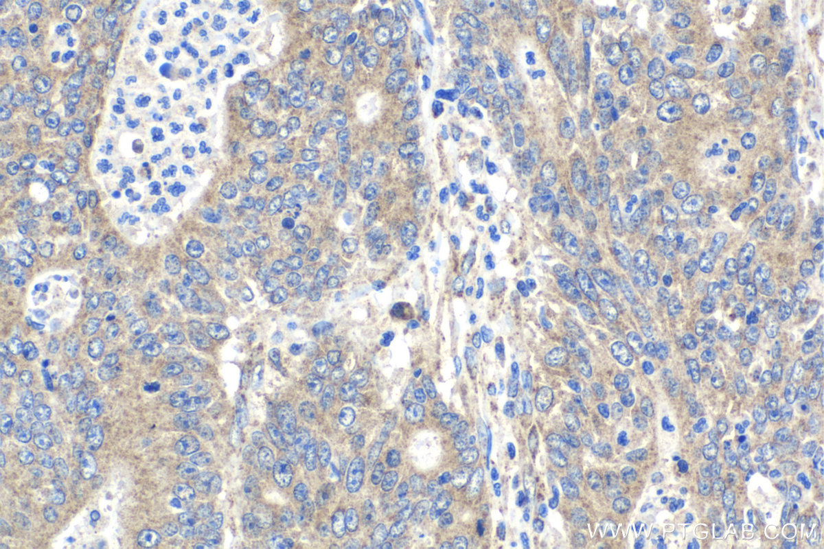 IHC staining of human colon cancer using 17400-1-AP