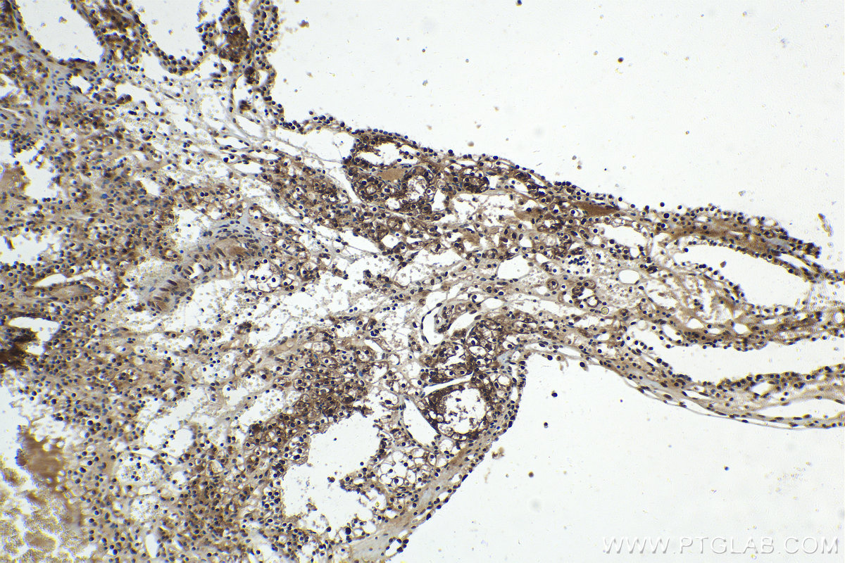 IHC staining of human renal cell carcinoma using 11234-1-AP