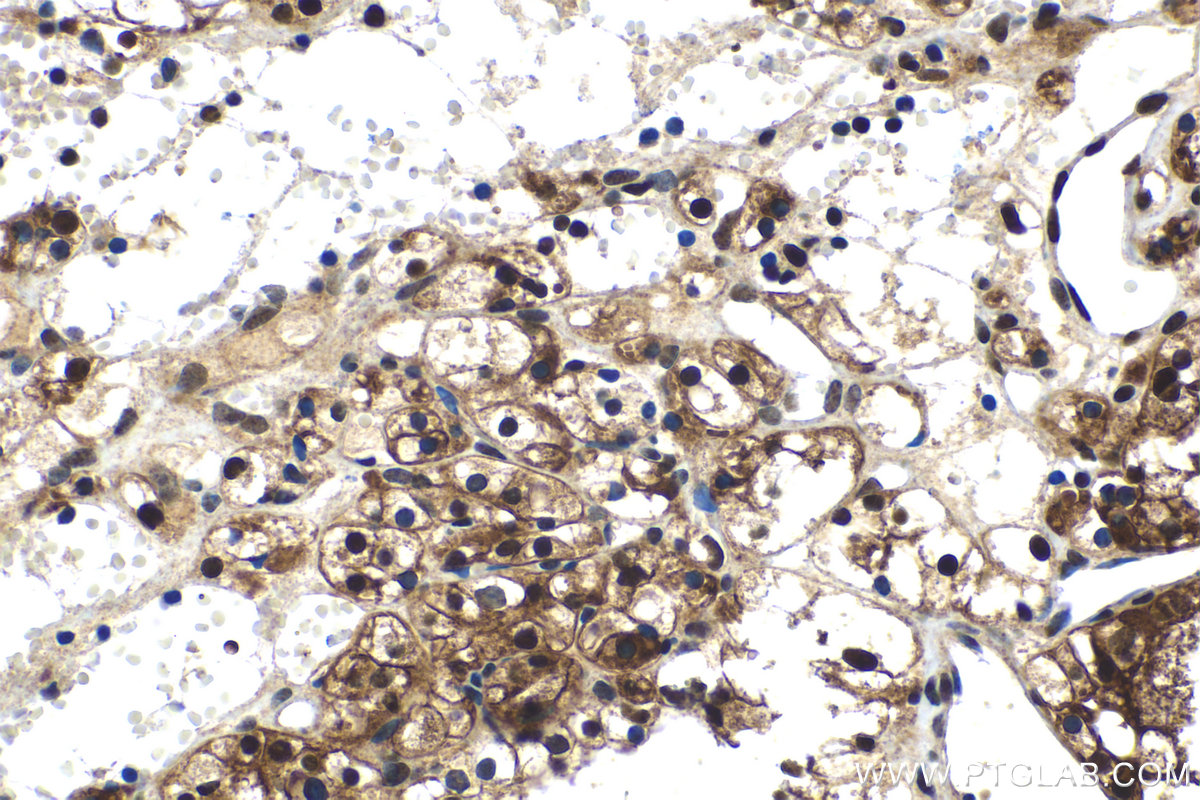 IHC staining of human renal cell carcinoma using 11234-1-AP