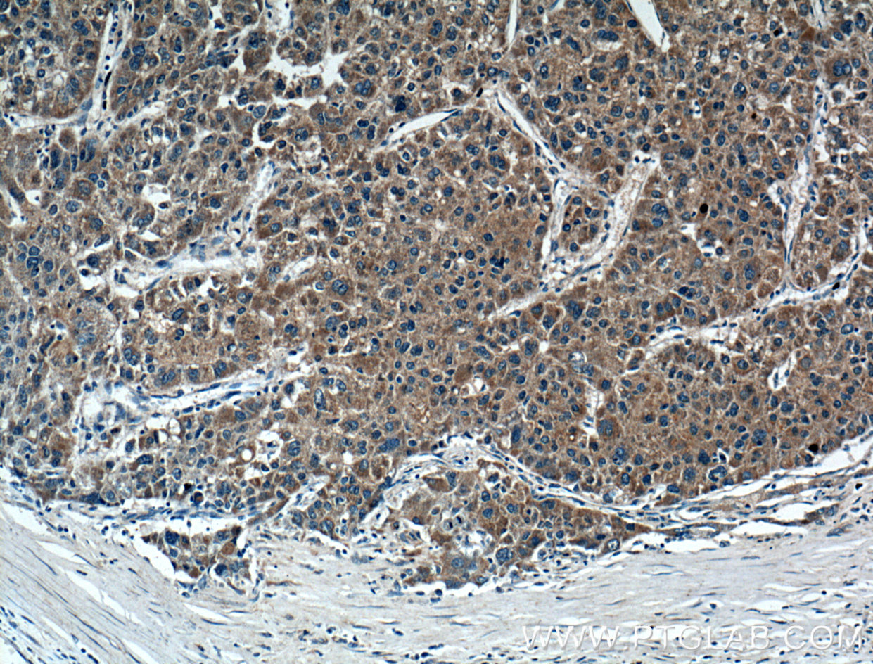 IHC staining of human liver cancer using 27100-1-AP