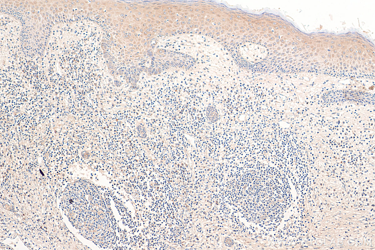 IHC staining of human skin cancer using 25006-1-AP