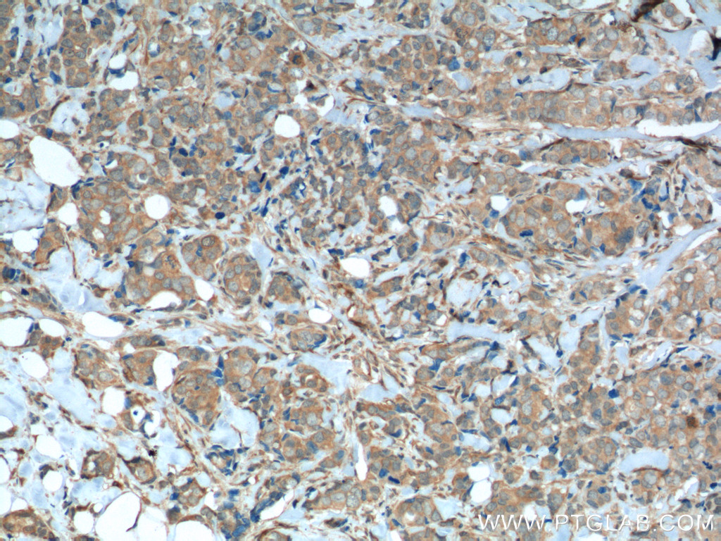 IHC staining of human breast cancer using 60325-1-Ig (same clone as 60325-1-PBS)