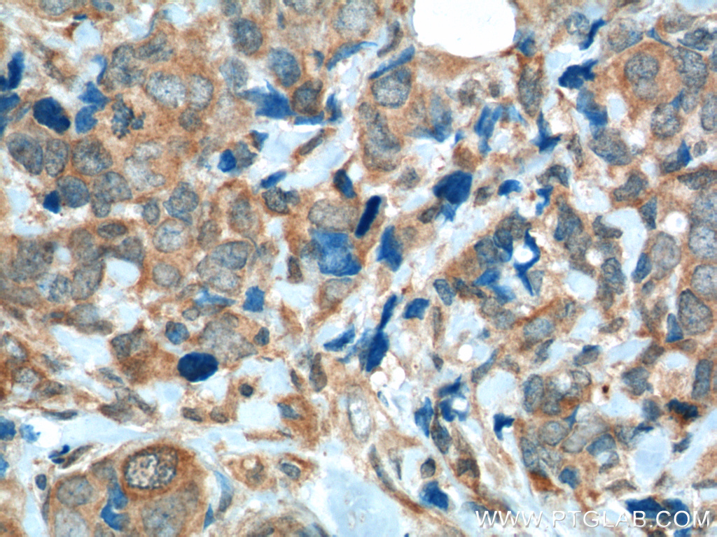 IHC staining of human breast cancer using 60325-1-Ig (same clone as 60325-1-PBS)