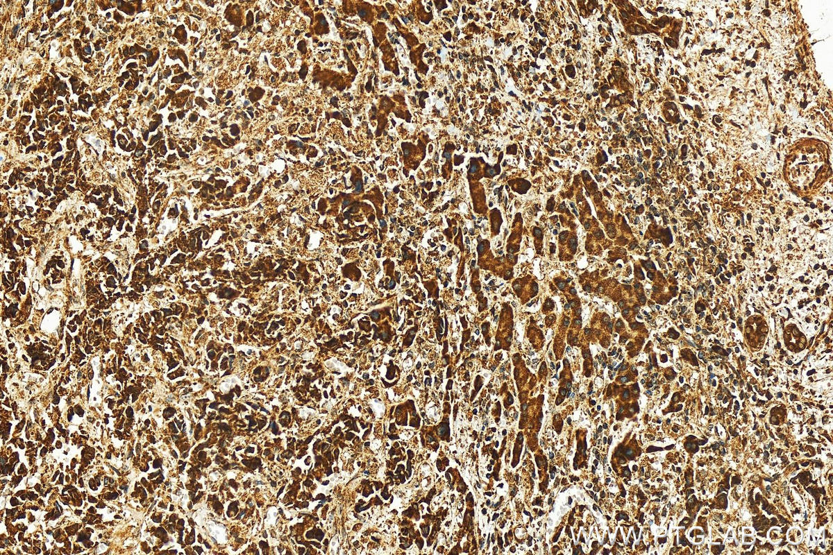 IHC staining of human intrahepatic cholangiocarcinoma using 11605-1-AP