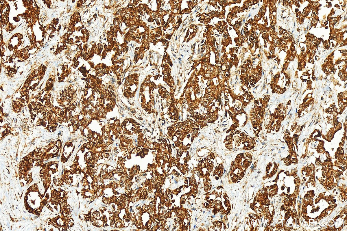 IHC staining of human intrahepatic cholangiocarcinoma using 11605-1-AP