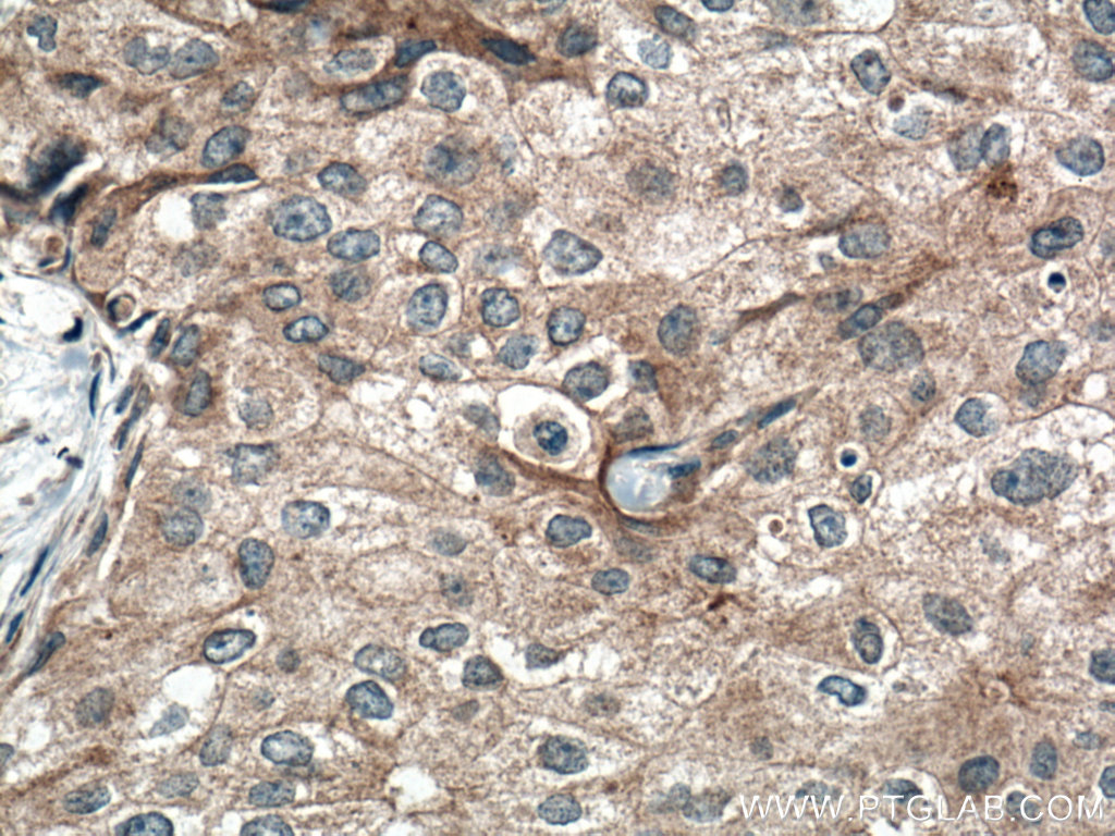 IHC staining of human breast cancer using 11098-1-AP