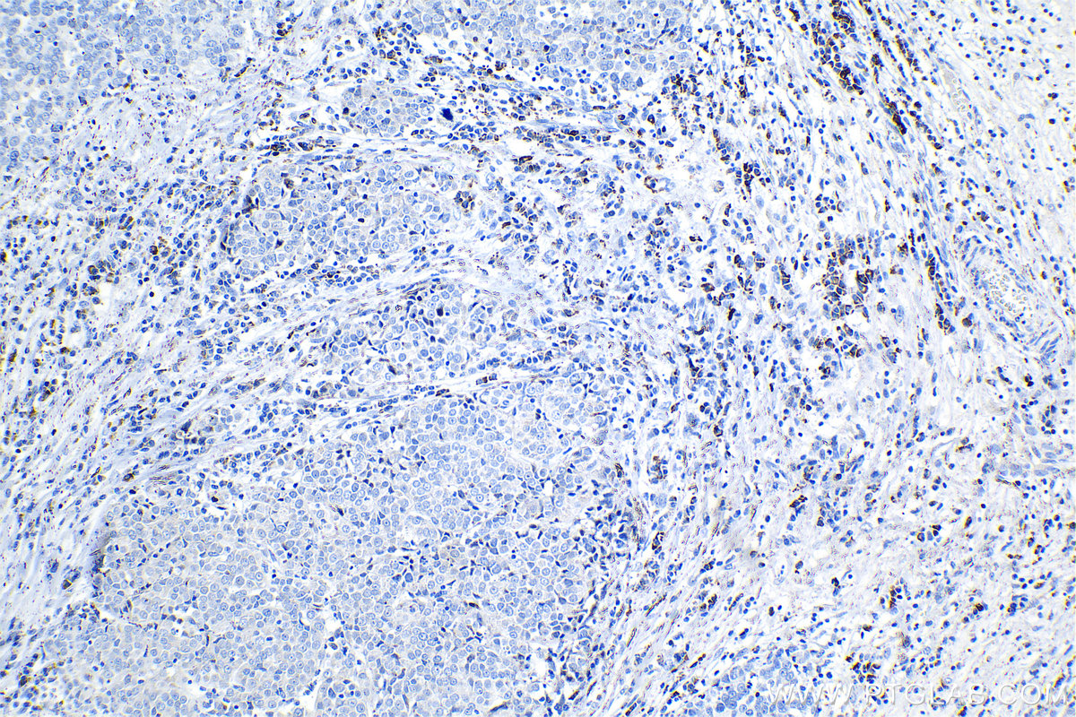 IHC staining of human ovary tumor using 81069-1-RR IHC staining of human ovary tumor using 81069-1-RR