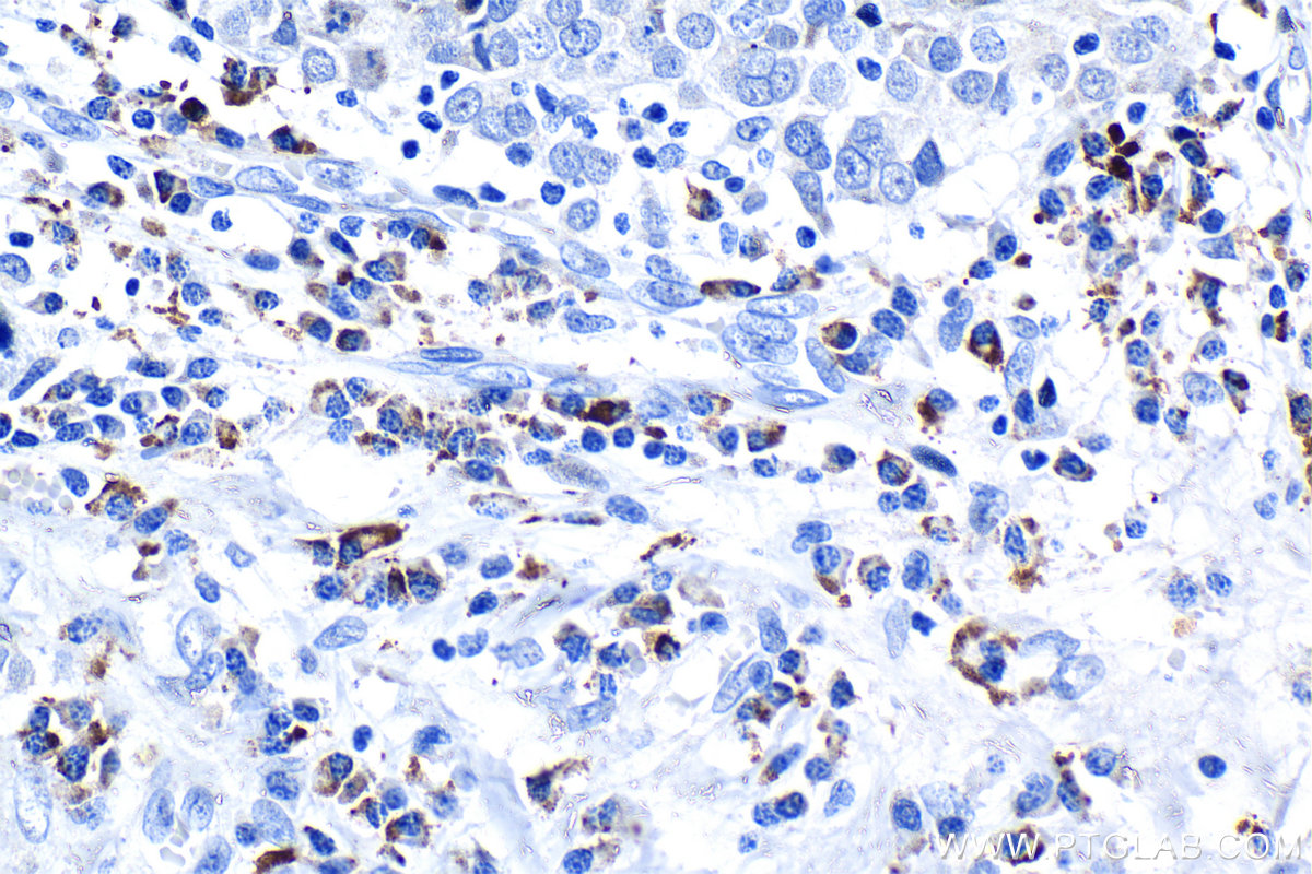 IHC staining of human ovary tumor using 81069-1-RR IHC staining of human ovary tumor using 81069-1-RR