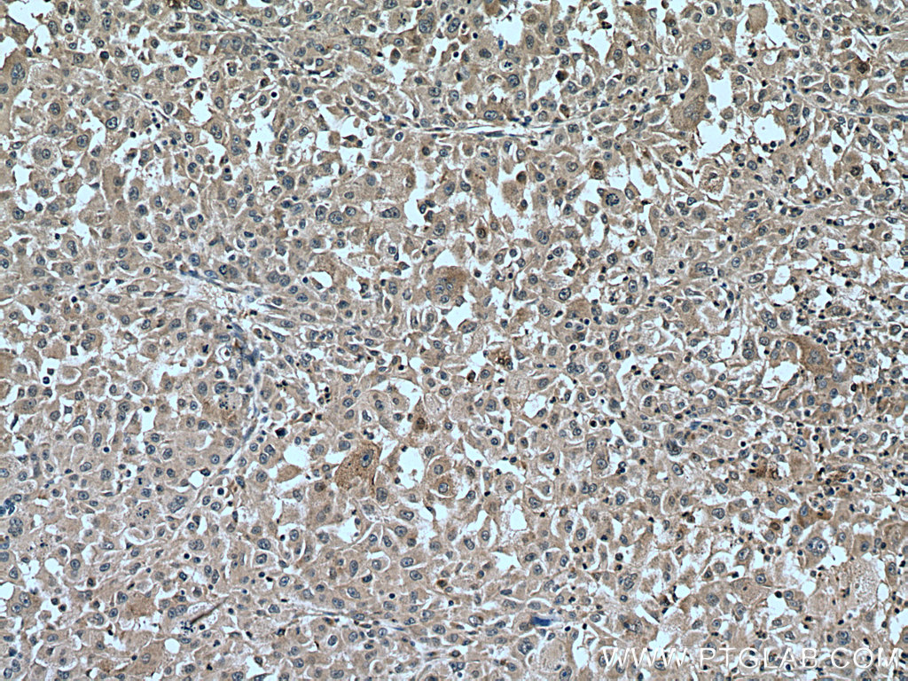 IHC staining of human liver cancer using 16000-1-AP