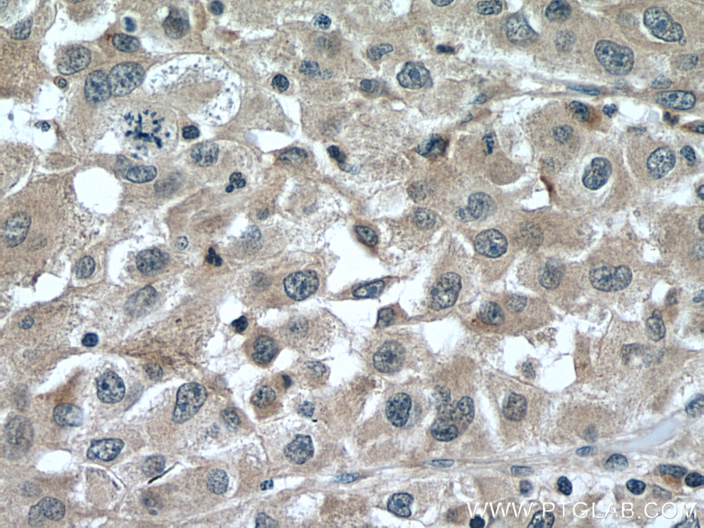 IHC staining of human liver cancer using 16000-1-AP