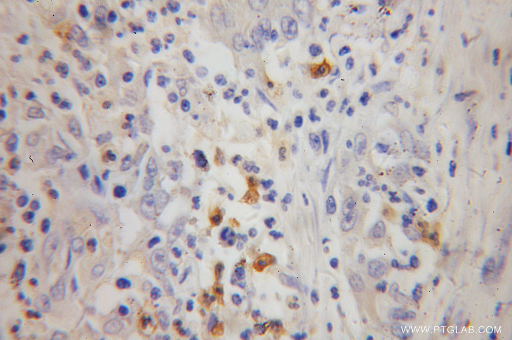 IHC staining of human colon cancer using 11827-1-AP