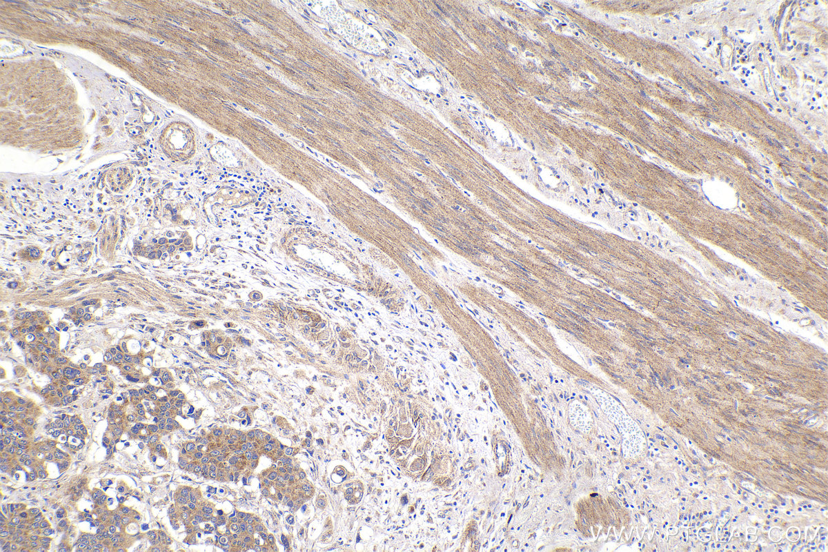 IHC staining of human stomach cancer using 68162-1-Ig (same clone as 68162-1-PBS)