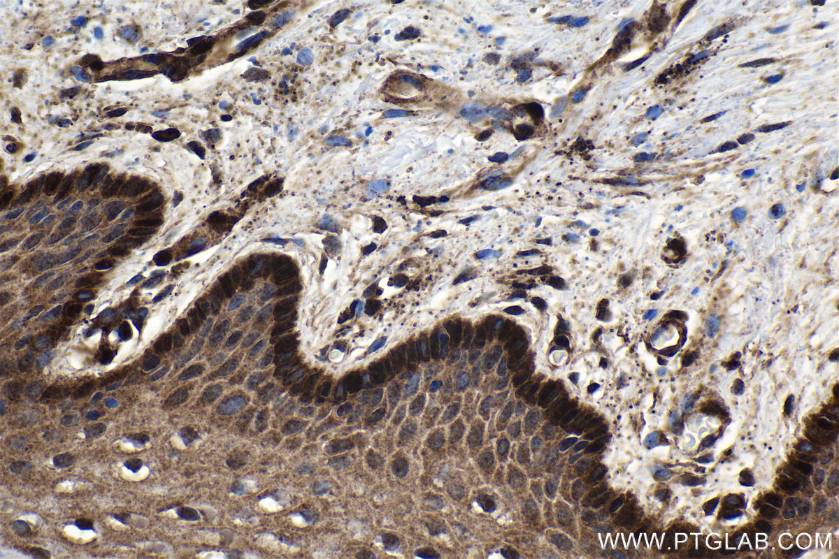 IHC staining of human cervical cancer using 21619-1-AP