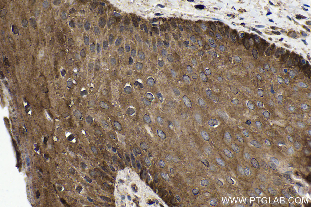 IHC staining of human skin cancer using 21619-1-AP