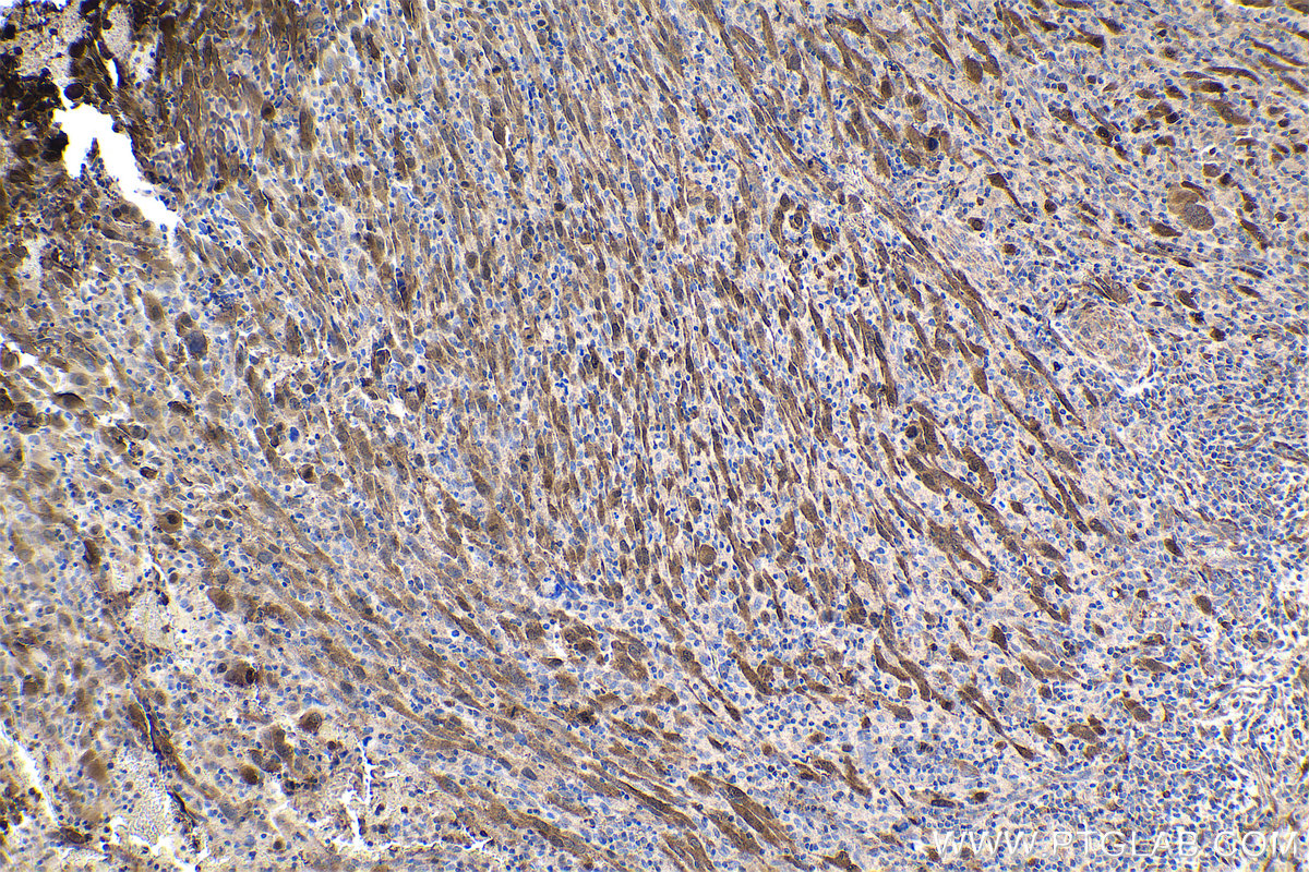 IHC staining of human skin cancer using 21619-1-AP