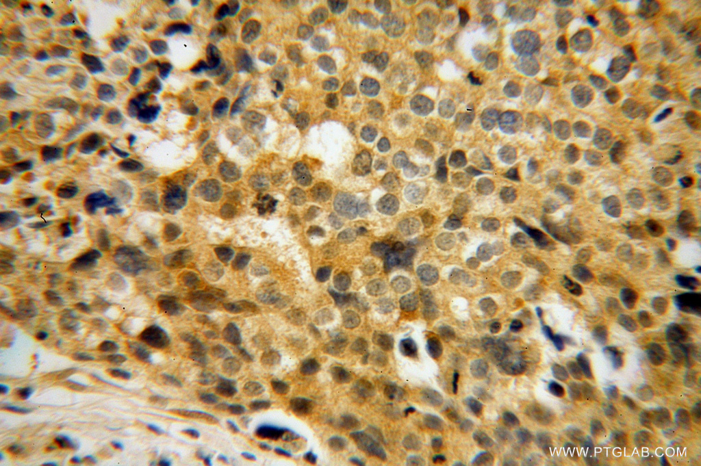 IHC staining of human ovary tumor using 11028-2-AP