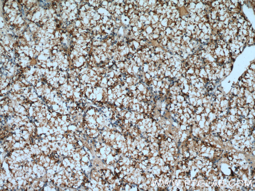 IHC staining of human renal cell carcinoma using 13875-1-AP