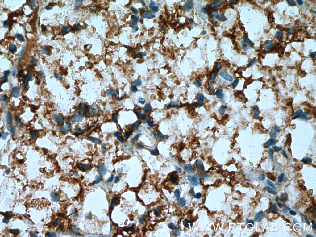 IHC staining of human renal cell carcinoma using 13875-1-AP