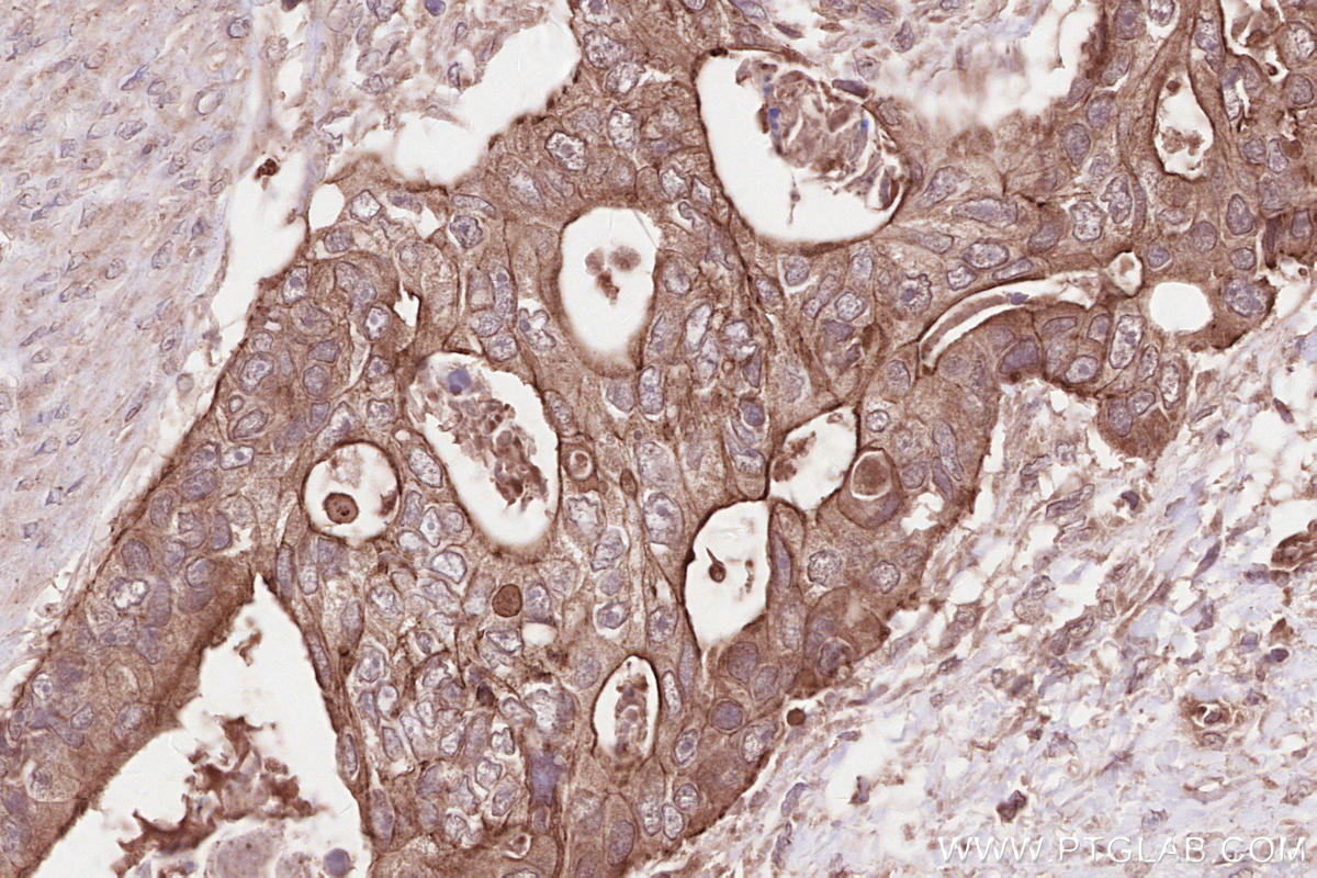 IHC staining of human stomach cancer using 17604-1-AP IHC staining of human stomach cancer using 17604-1-AP