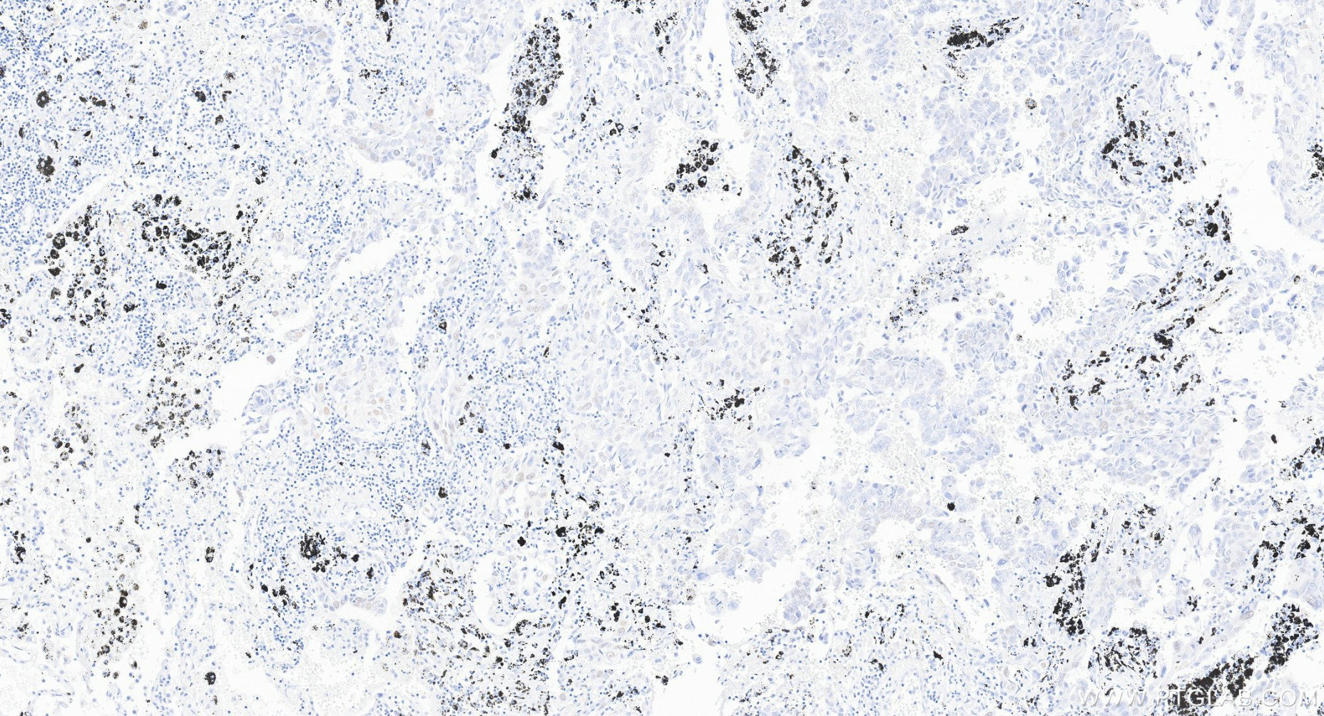 IHC staining of Human lung cancer (Adenocarcinoma) using 86971-1-RR IHC staining of Human lung cancer (Adenocarcinoma) using 86971-1-RR