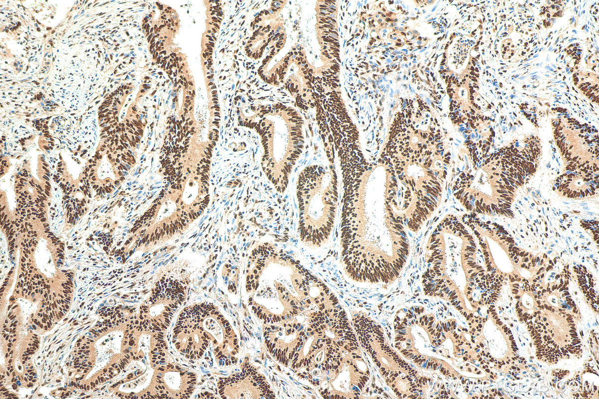 IHC staining of human colon cancer using 12276-1-AP