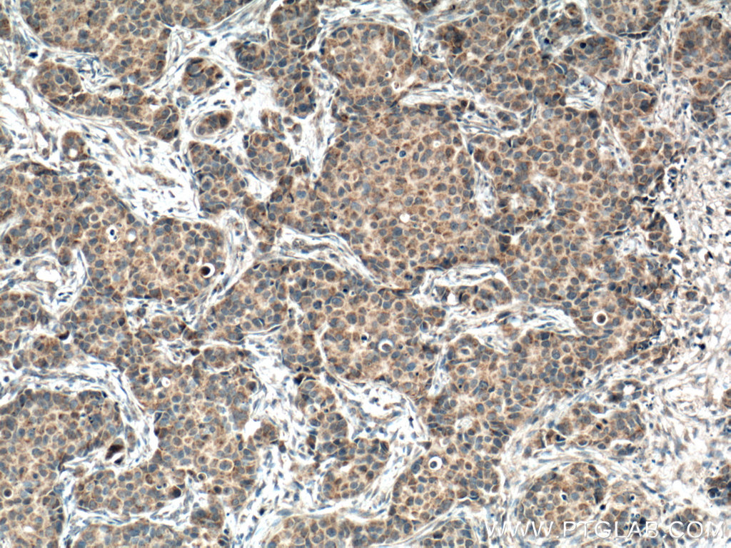 IHC staining of human breast cancer using 66635-1-Ig (same clone as 66635-1-PBS)