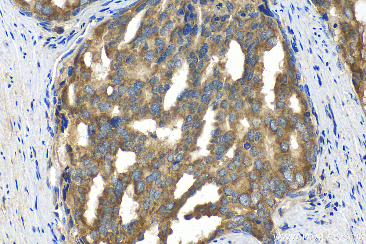 IHC staining of human prostate cancer using 82248-1-RR (same clone as 82248-1-PBS)