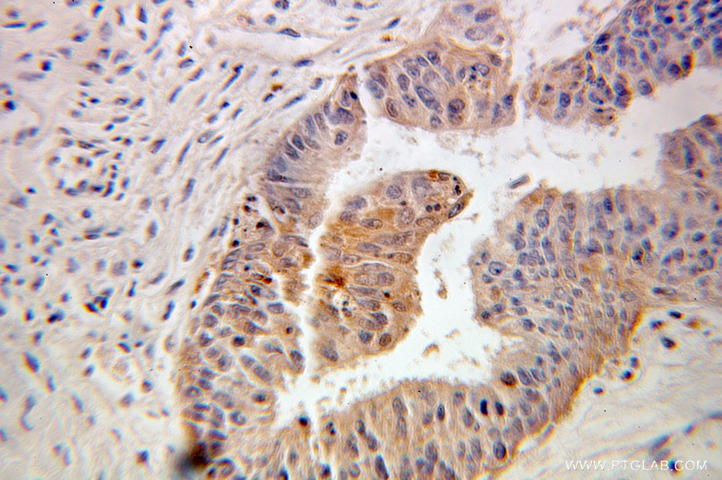 IHC staining of human ovary tumor using 10273-1-AP