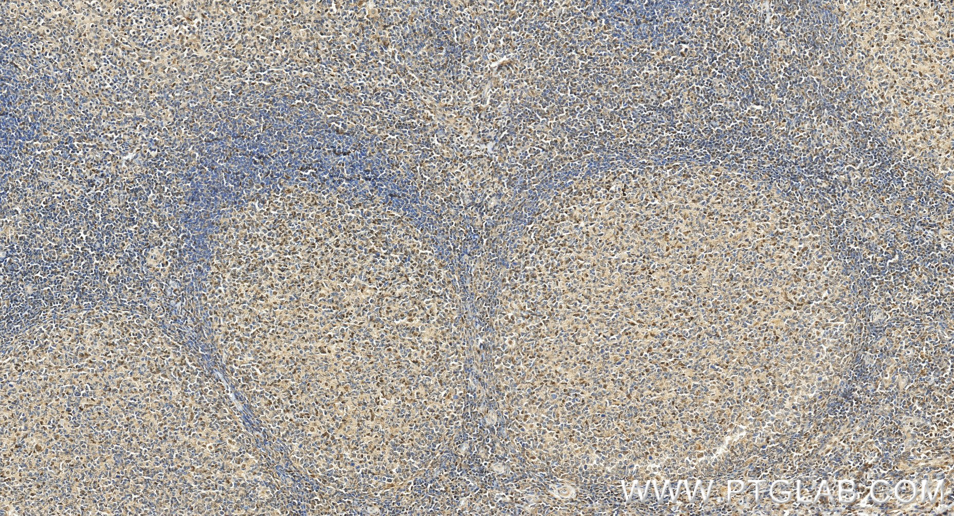 IHC staining of human tonsillitis using 86189-2-RR