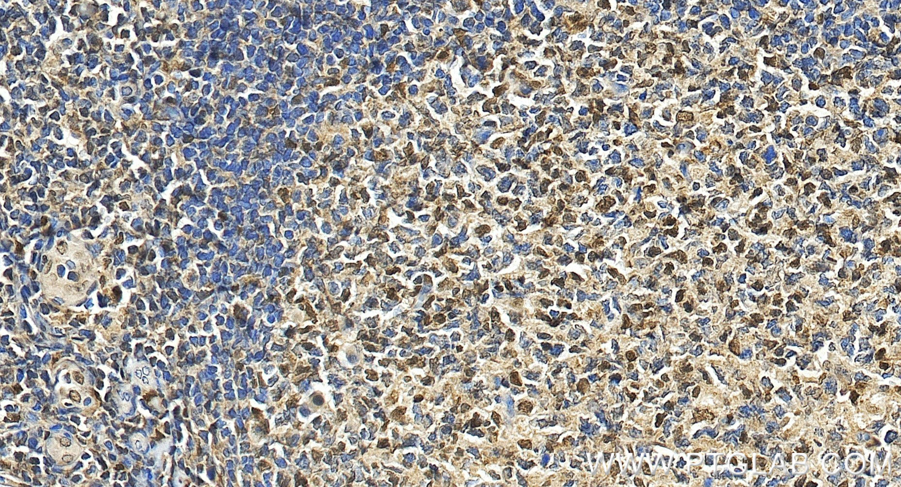 IHC staining of human tonsillitis using 86189-2-RR