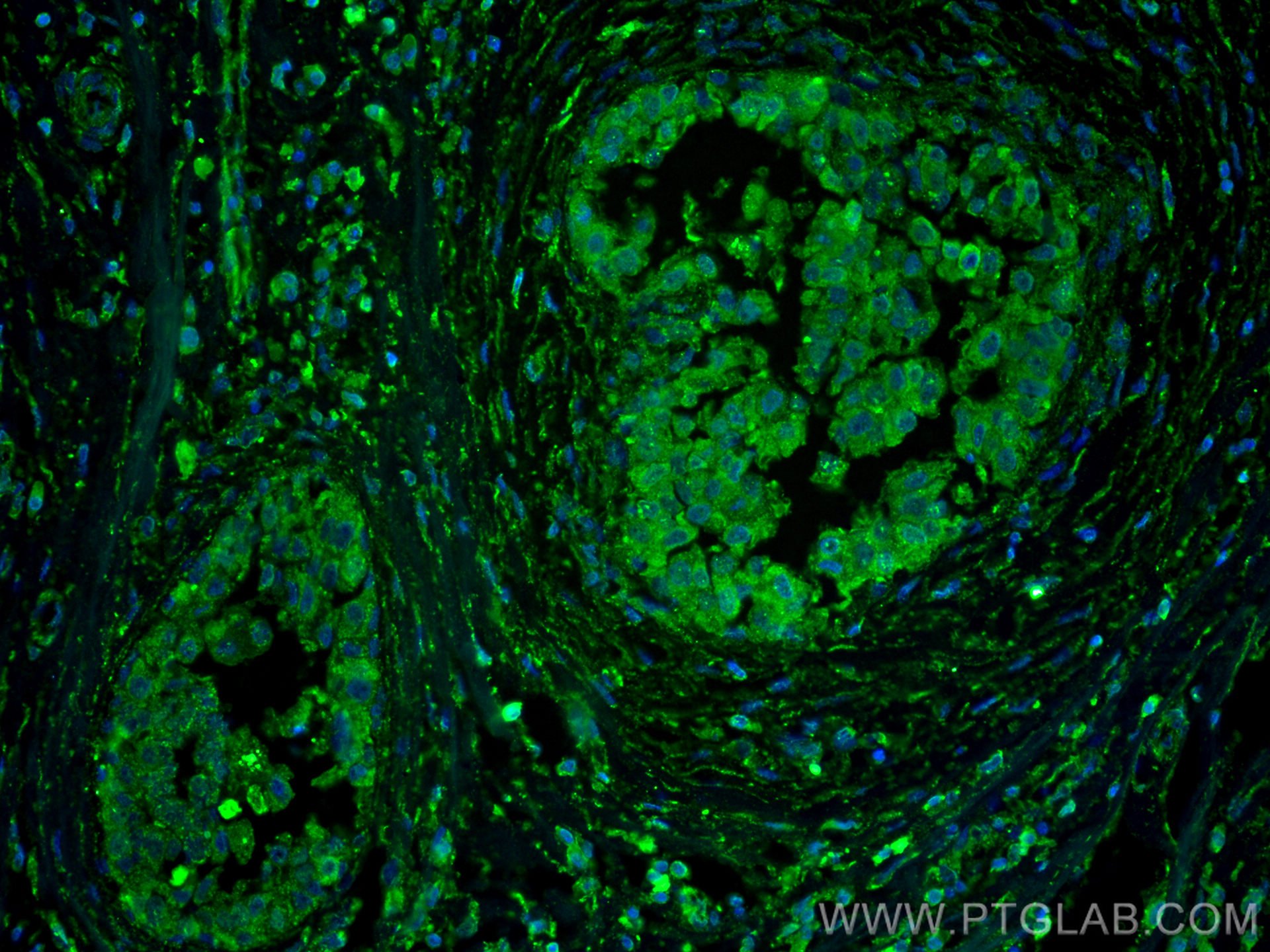 IF Staining of human breast cancer using 66040-2-Ig