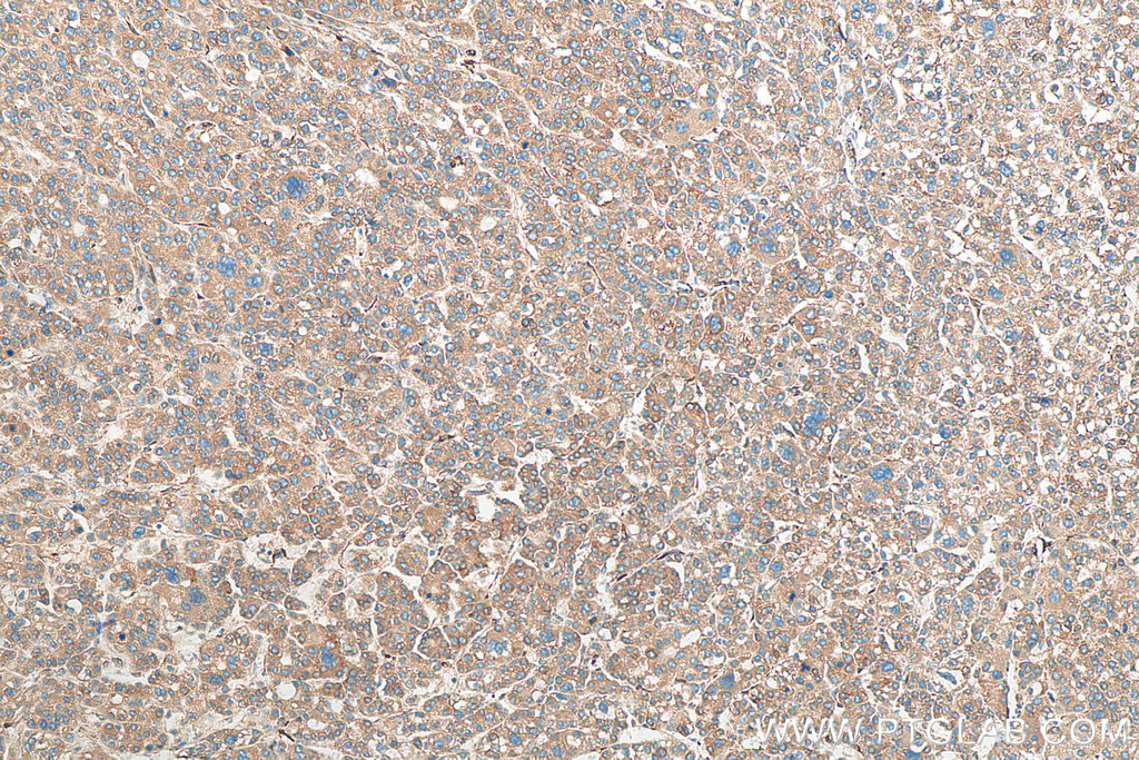 IHC staining of human liver cancer using 12092-1-AP