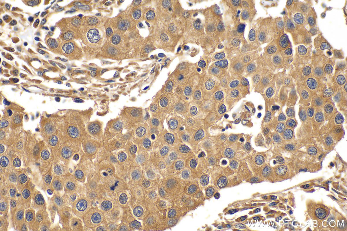 IHC staining of human breast cancer using 10060-1-AP