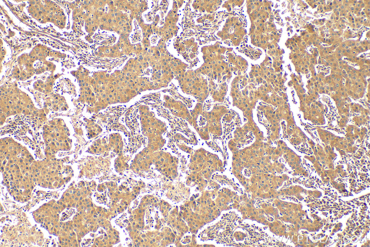 IHC staining of human breast cancer using 10060-1-AP