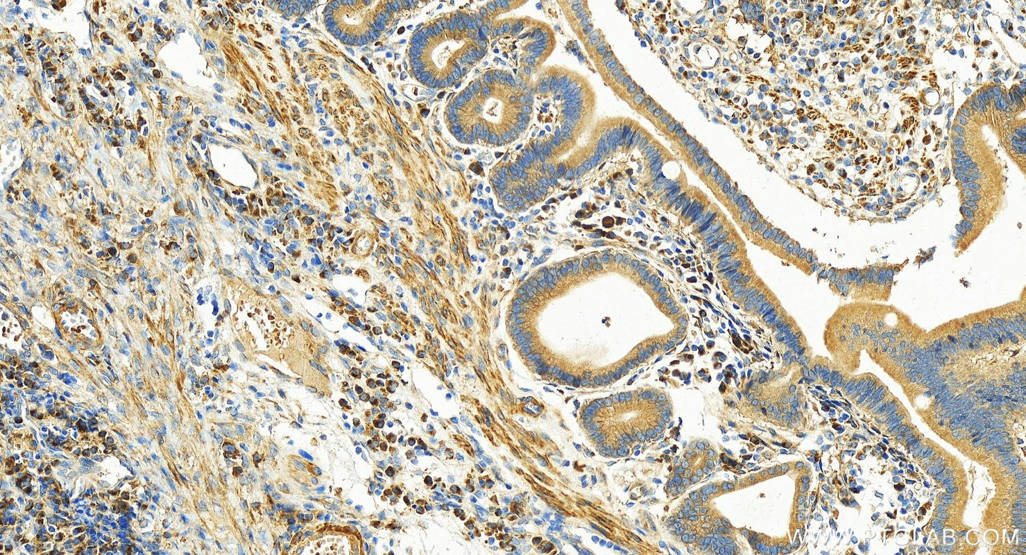 IHC staining of human stomach cancer using 26355-1-AP