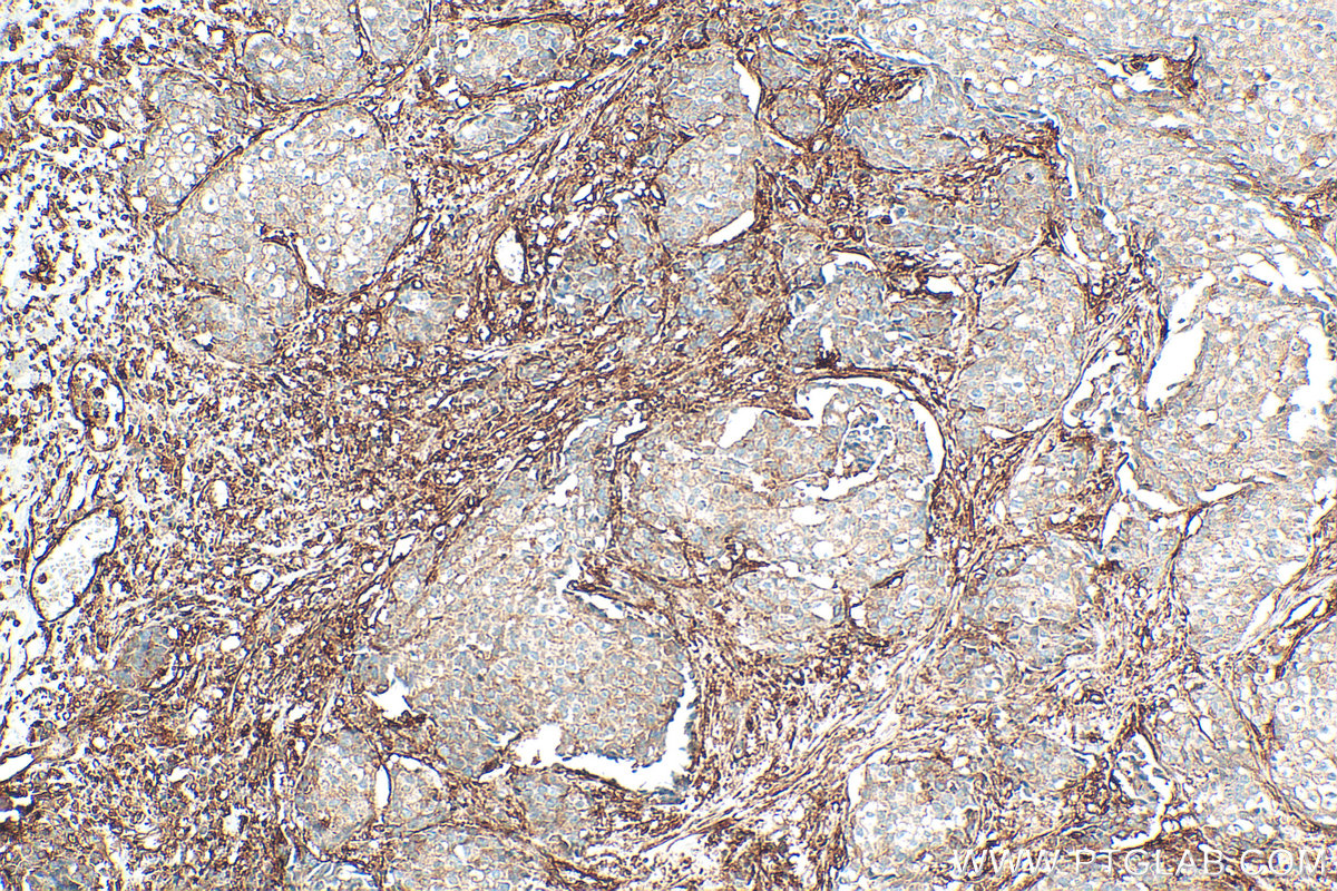 IHC staining of human breast cancer using 11140-1-AP IHC staining of human breast cancer using 11140-1-AP