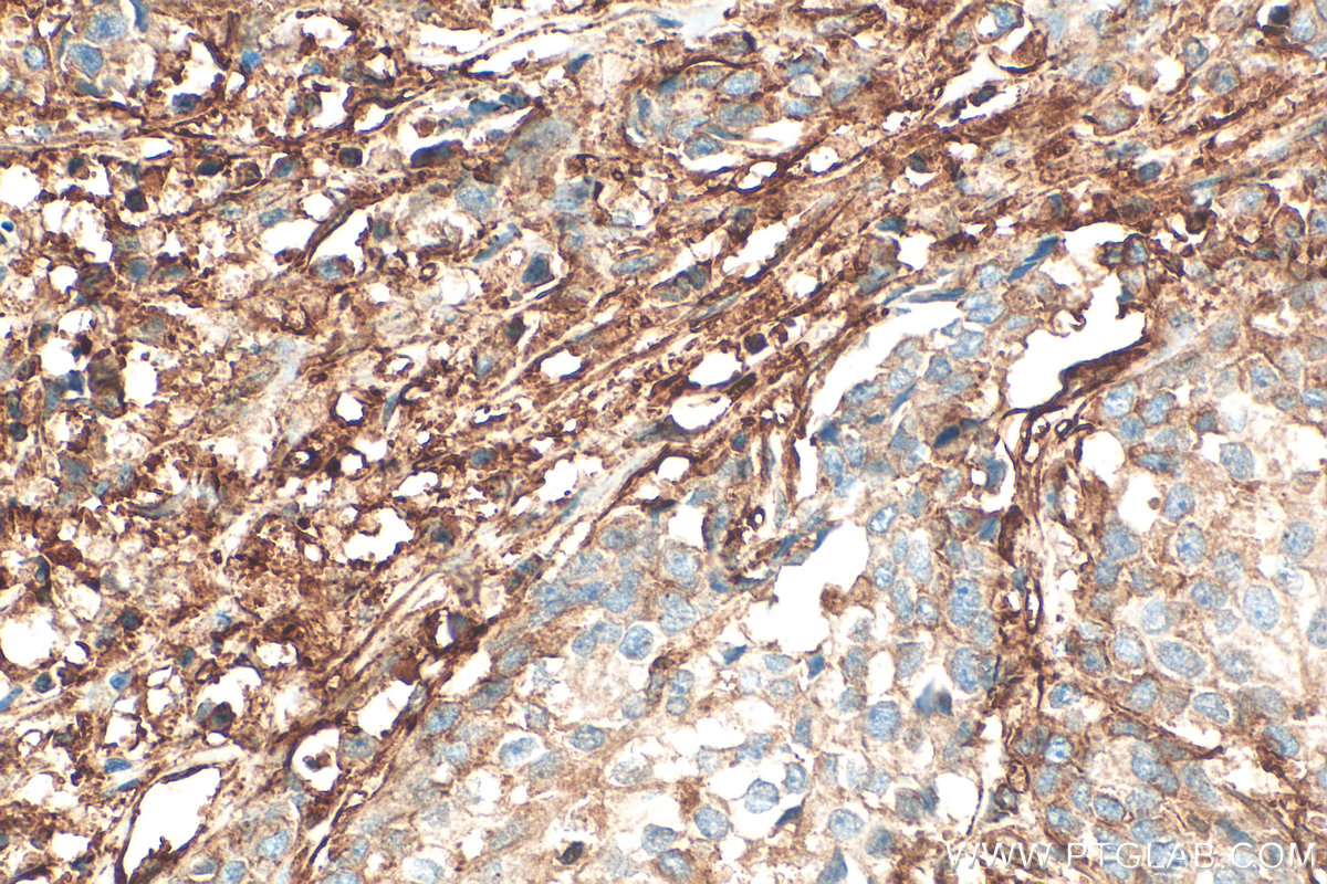 IHC staining of human breast cancer using 11140-1-AP IHC staining of human breast cancer using 11140-1-AP