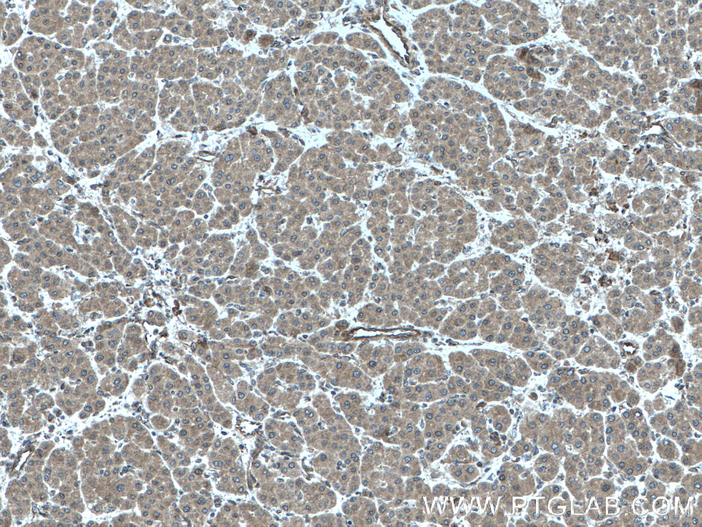 IHC staining of human liver cancer using 20685-1-AP