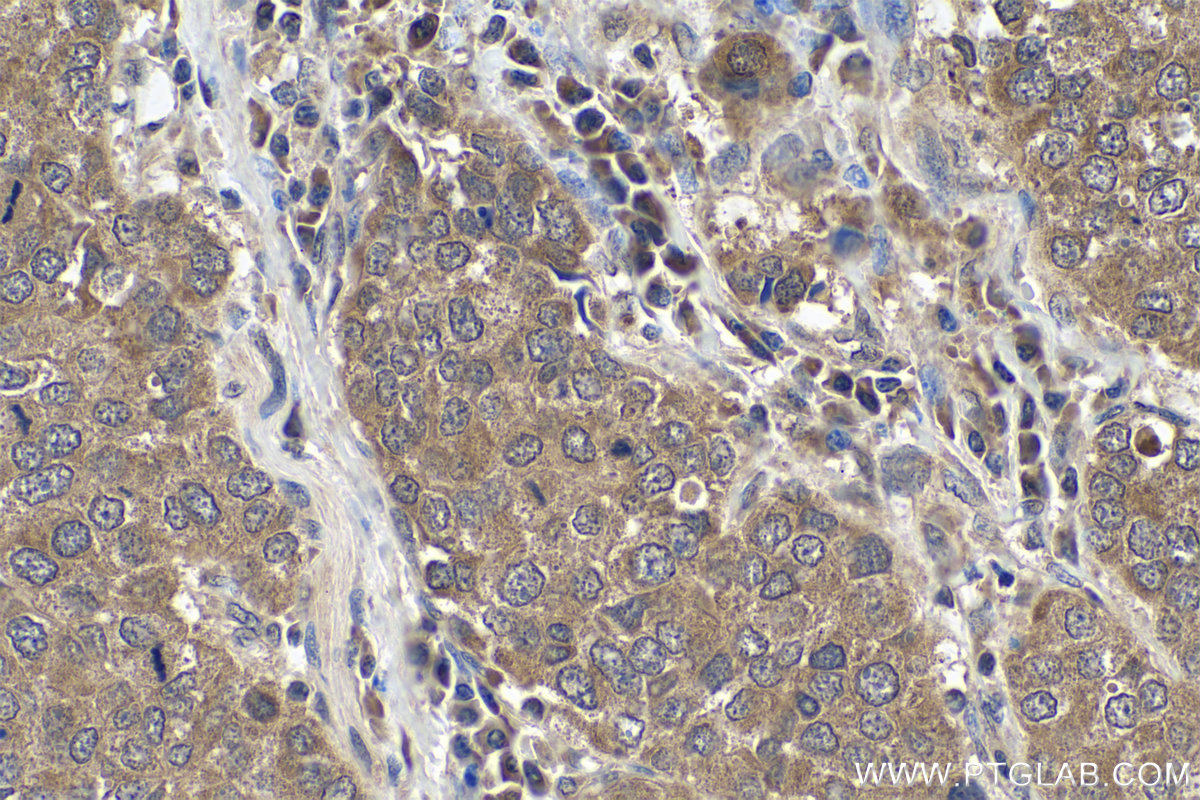 IHC staining of human stomach cancer using 24228-1-AP
